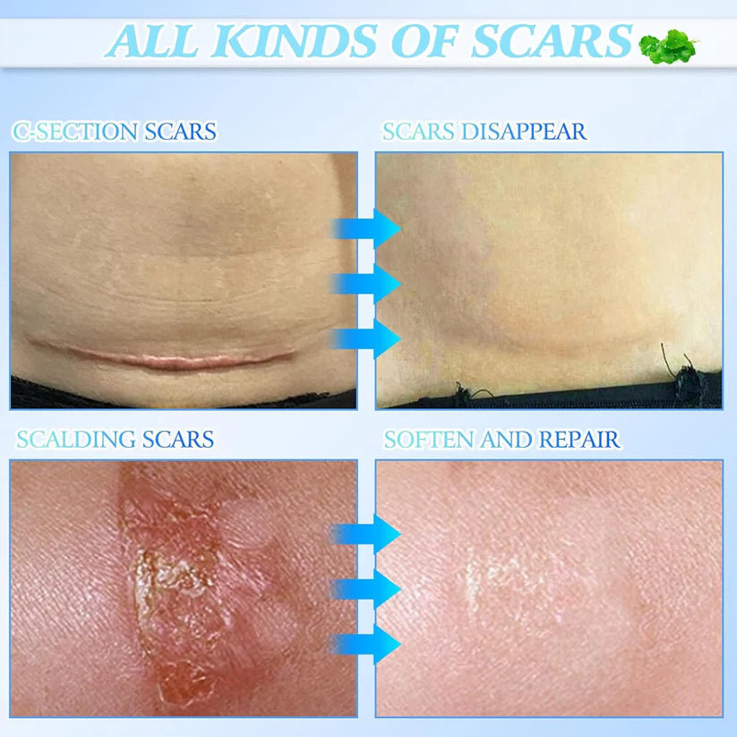 Skin Smoothing Scar Cream, Lighten & Repair All Scars